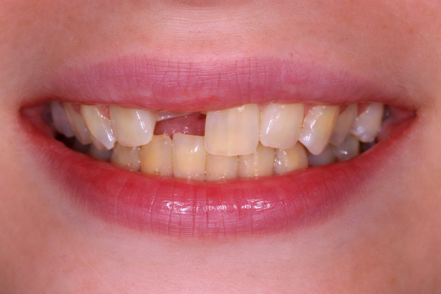 Professional Teeth Whitening Result before image