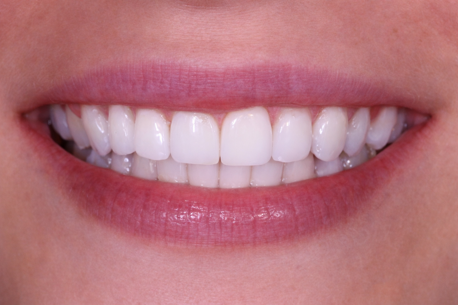 Professional Teeth Whitening Result after image