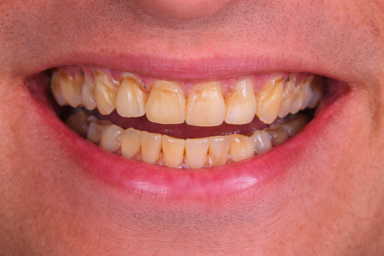The Dental Way Bergenfield before and after smile result