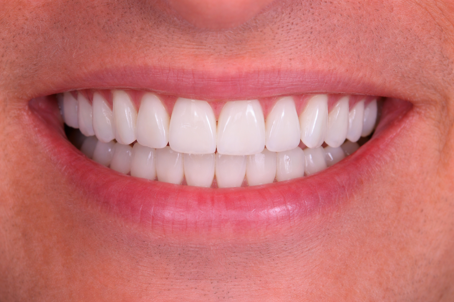 The Dental Way Bergenfield before and after smile result